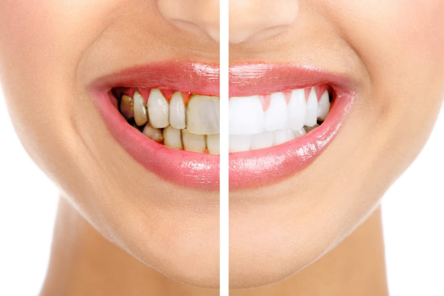 Как отбелить зубы в домашних условиях: советы и рекомендации 1 Как отбелить зубы в домашних условиях