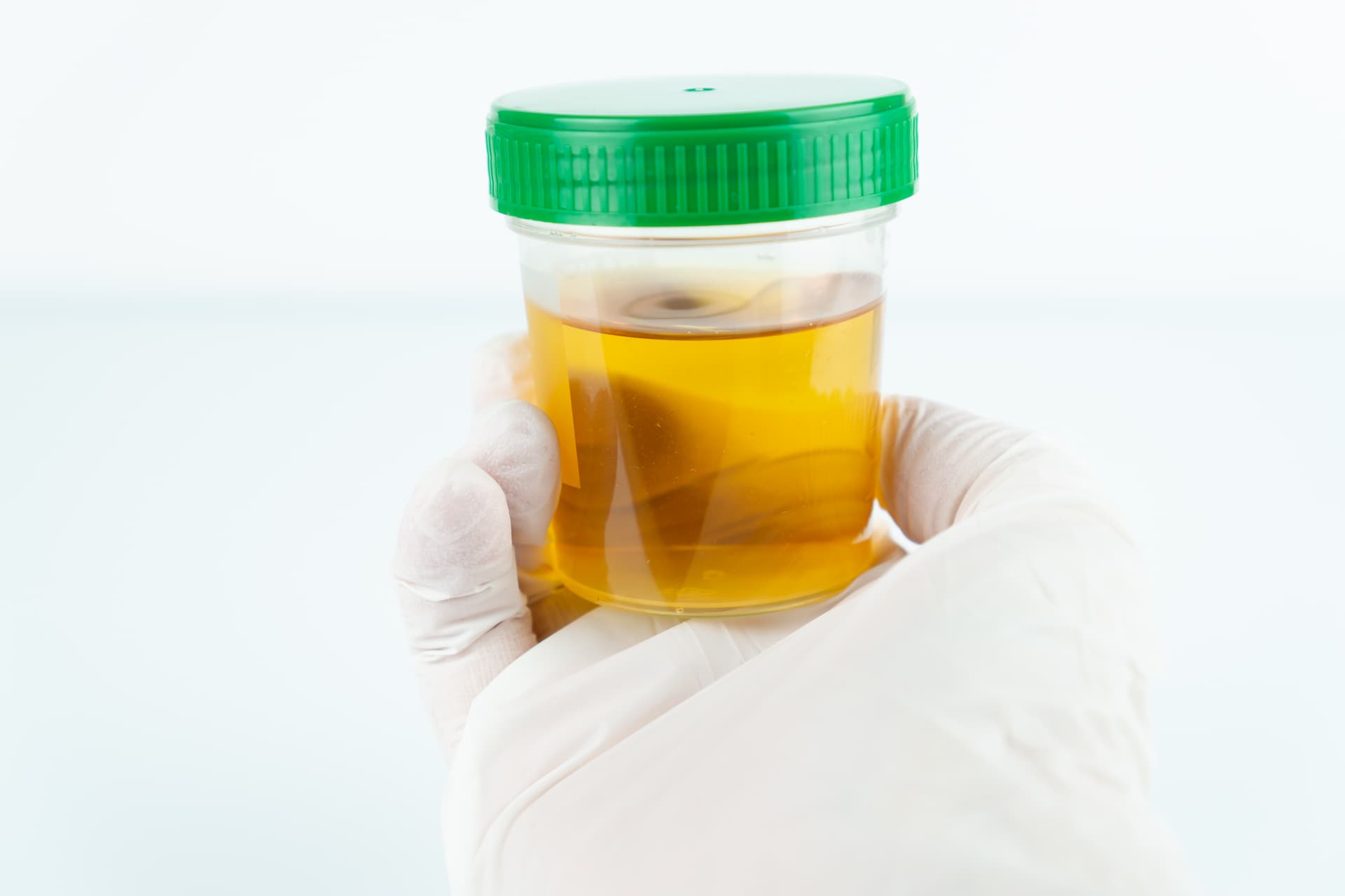 Белок в моче и соотношение белка к креатинину в моче 1